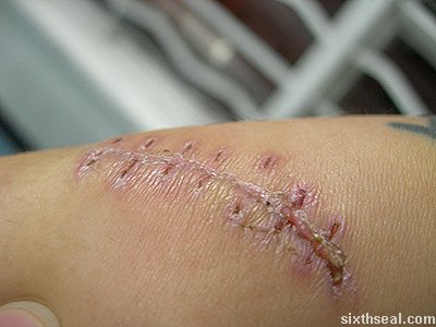 The picture above shows the scar from the previous hospitalization 